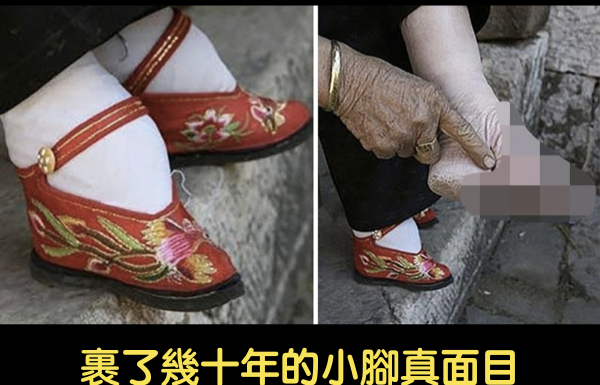 裹了幾十年小腳的真面目,用X光一照更是嚇人!
